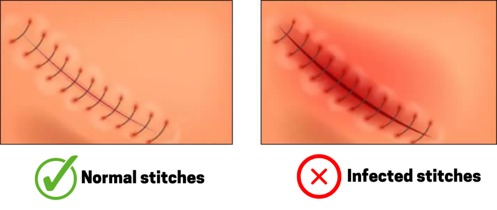 signs of infected wounds