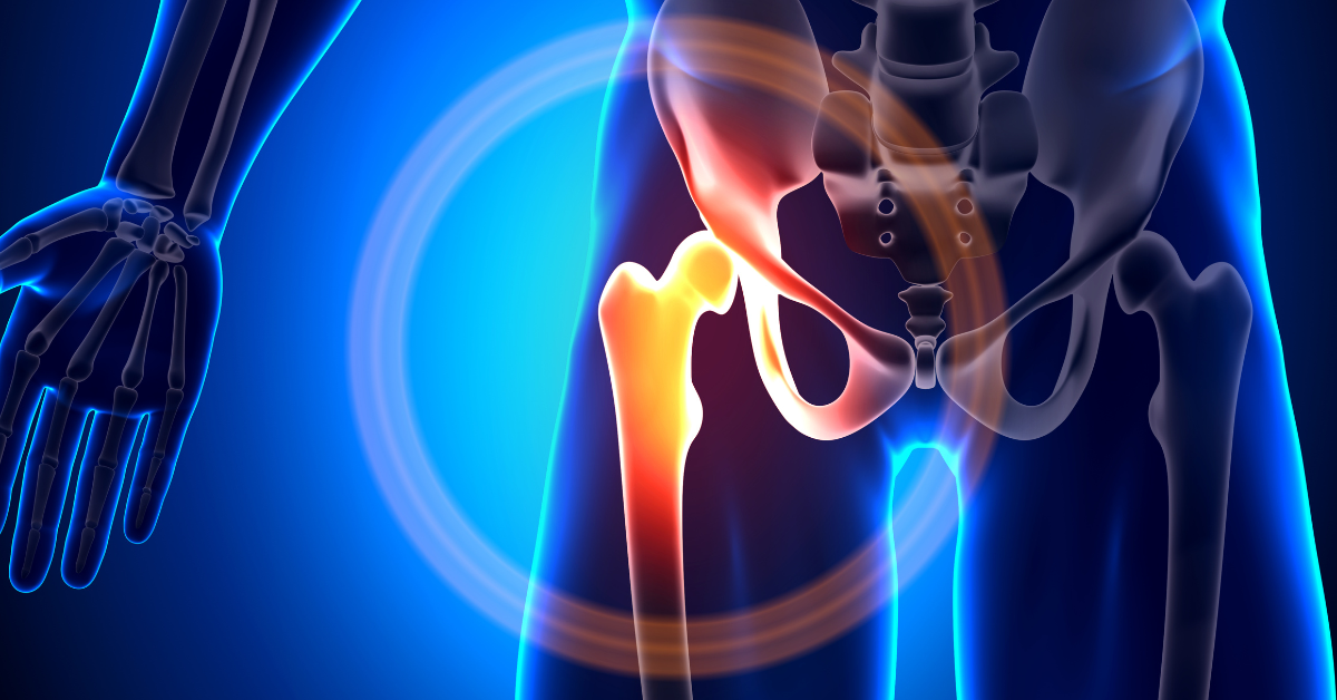 The Best Hip Impingement Exercises