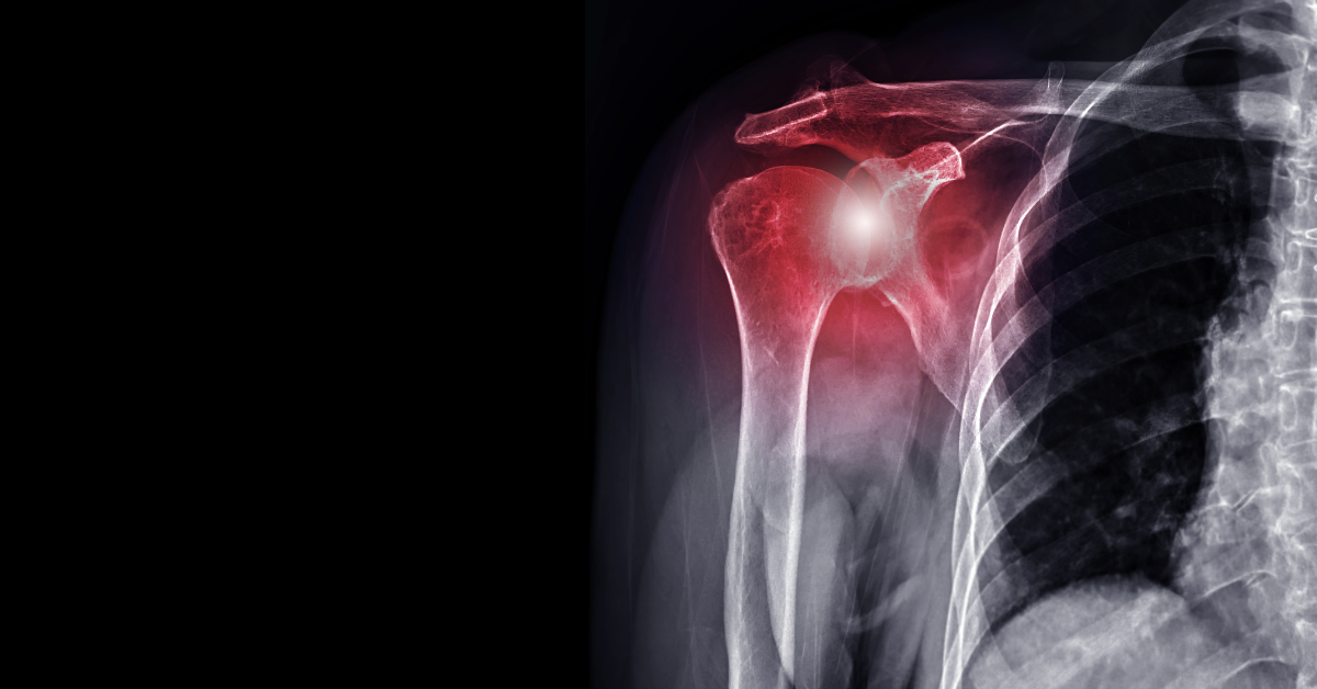 Shoulder Instability in Athletes